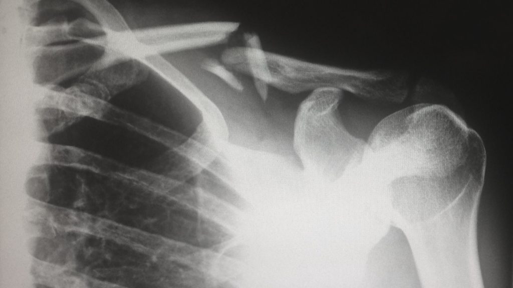 Radiografia lesión clavícula